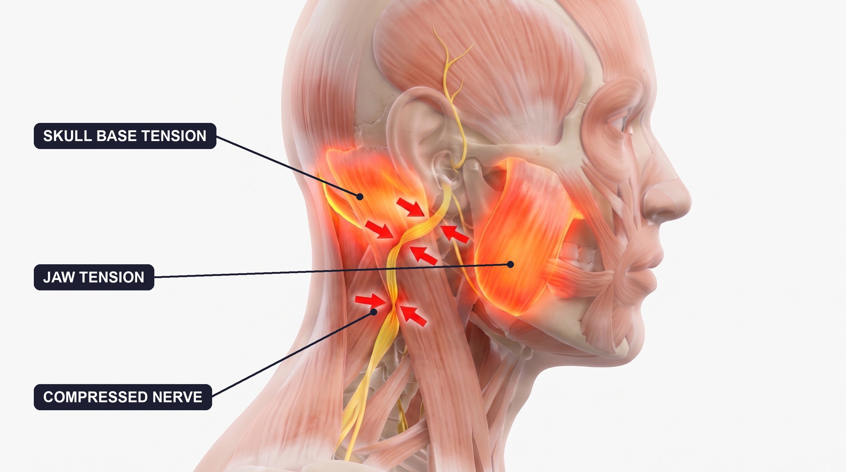Jaw and skull base tension compressing the auditory nerve