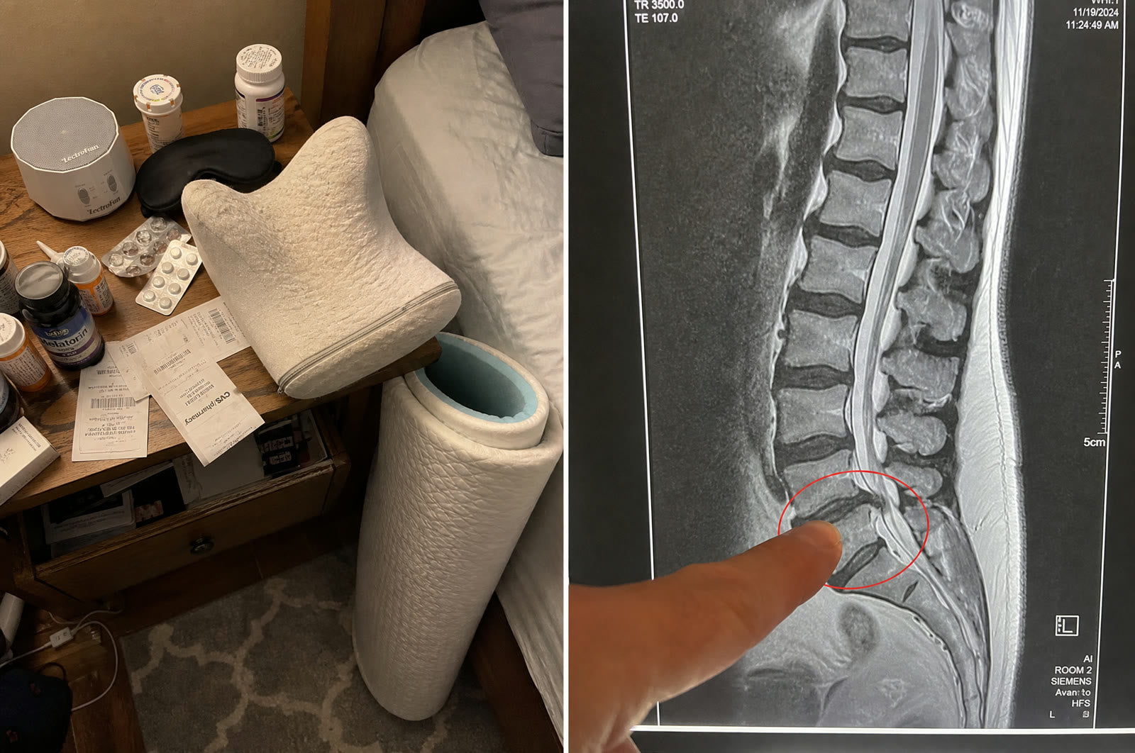 A nightstand full of failed sleep solutions next to a lumbar MRI with a red circle
